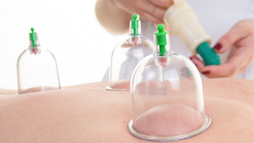 Cupping Therapy