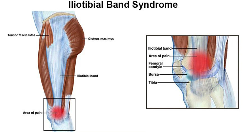 Iliotibial band syndrome