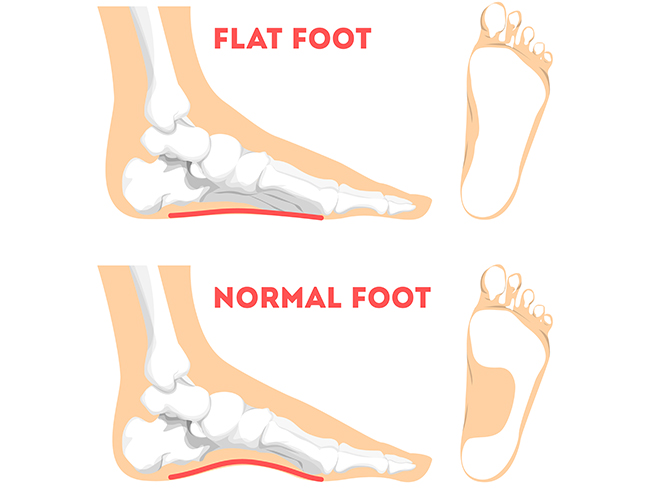 Flat Foot
